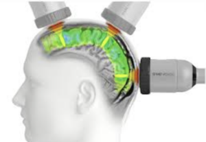 Transcranial Pulse Stimulation